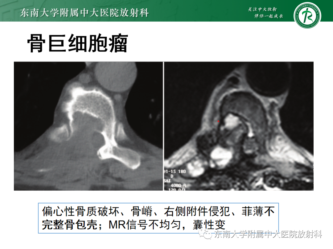 影像PPT - 【PPT】椎体孤立性肿瘤的诊断思路-27 影像PPT - 【PPT】椎体孤立性肿瘤的诊断思路-27