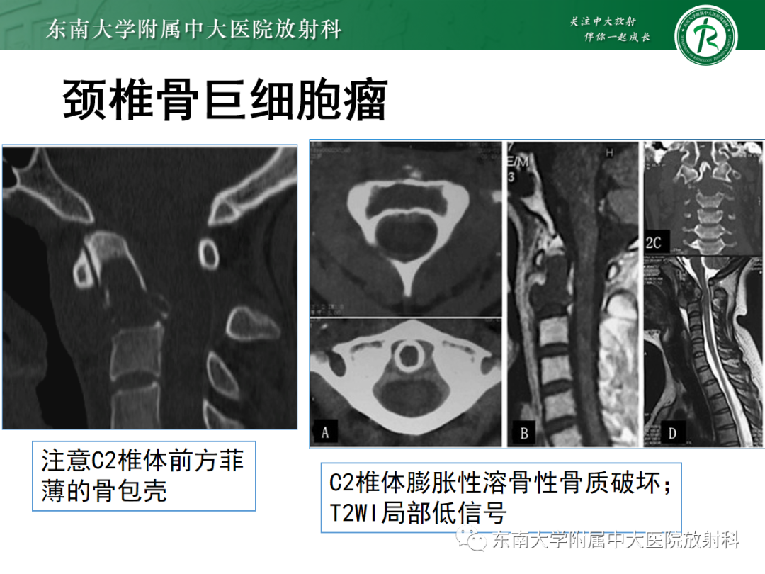 影像PPT - 【PPT】椎体孤立性肿瘤的诊断思路-28 影像PPT - 【PPT】椎体孤立性肿瘤的诊断思路-28