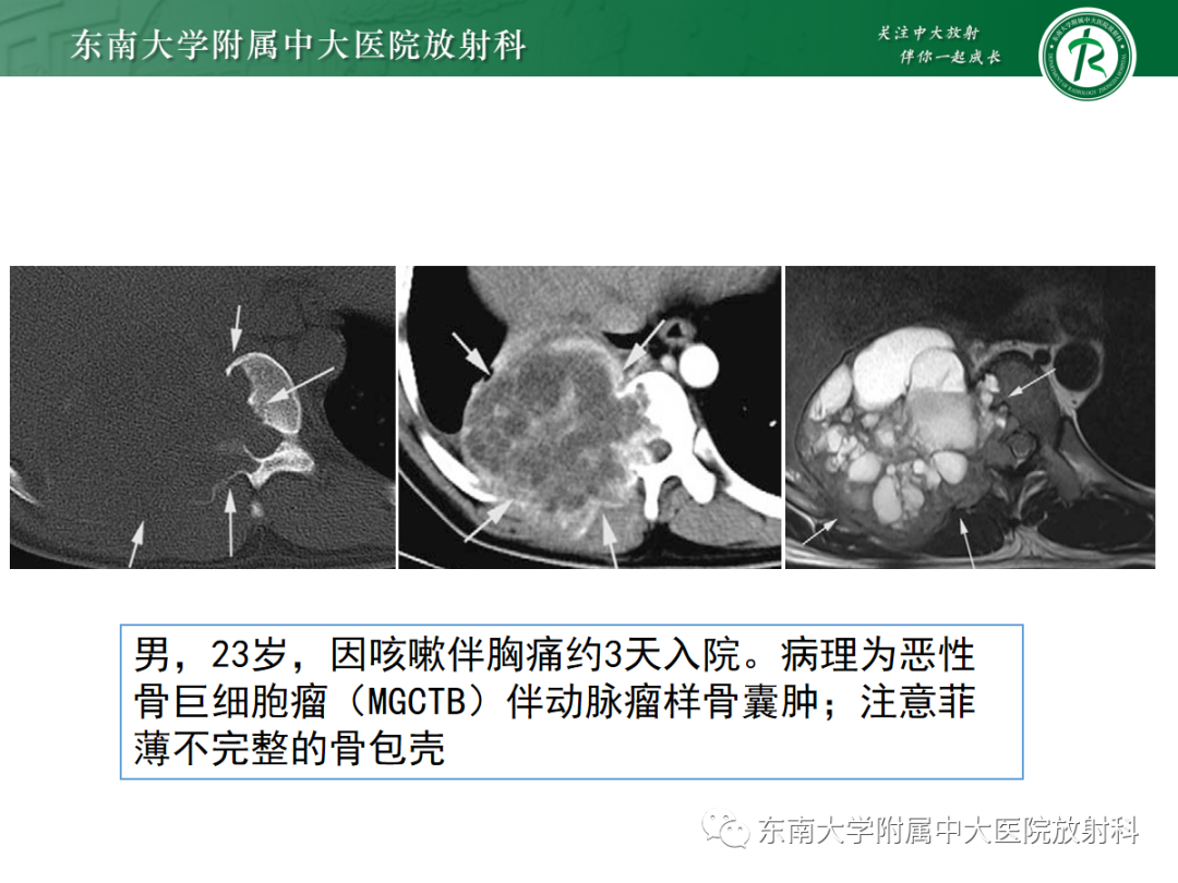 影像PPT - 【PPT】椎体孤立性肿瘤的诊断思路-29 影像PPT - 【PPT】椎体孤立性肿瘤的诊断思路-29