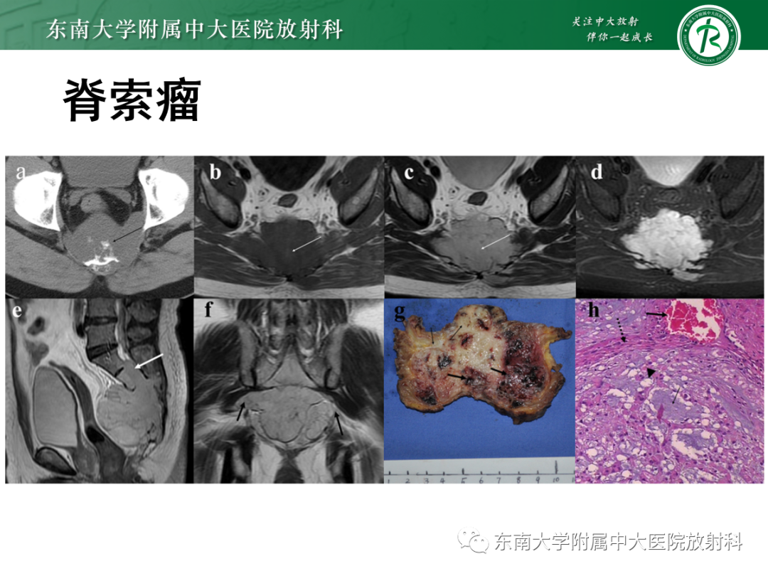 影像PPT - 【PPT】椎体孤立性肿瘤的诊断思路-31 影像PPT - 【PPT】椎体孤立性肿瘤的诊断思路-31