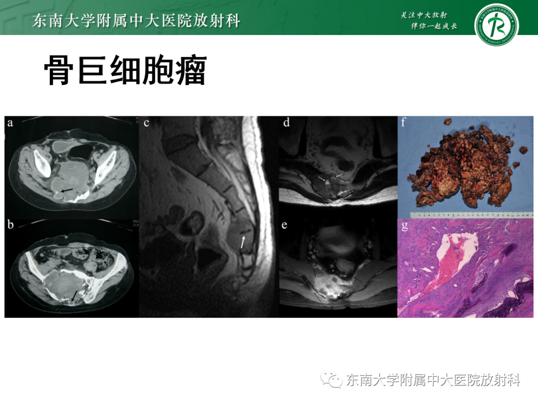 影像PPT - 【PPT】椎体孤立性肿瘤的诊断思路-32 影像PPT - 【PPT】椎体孤立性肿瘤的诊断思路-32