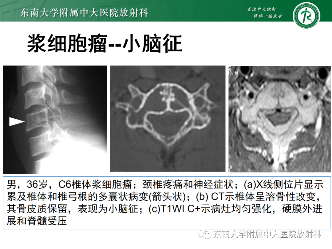 影像PPT - 【PPT】椎体孤立性肿瘤的诊断思路-34 影像PPT - 【PPT】椎体孤立性肿瘤的诊断思路-34