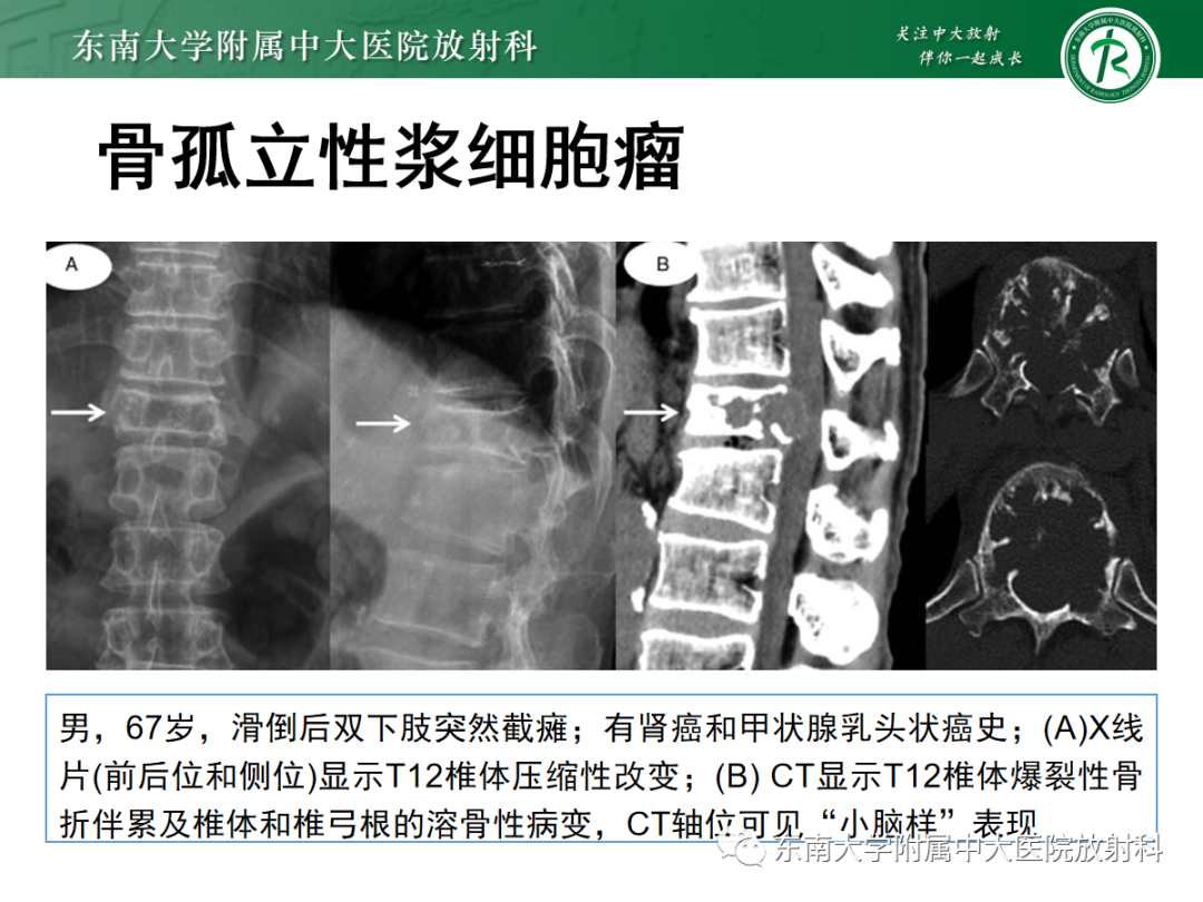 影像PPT - 【PPT】椎体孤立性肿瘤的诊断思路-35 影像PPT - 【PPT】椎体孤立性肿瘤的诊断思路-35