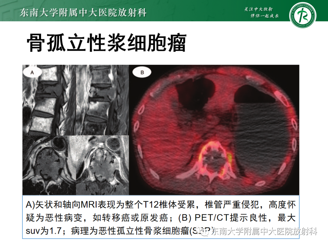 影像PPT - 【PPT】椎体孤立性肿瘤的诊断思路-36 影像PPT - 【PPT】椎体孤立性肿瘤的诊断思路-36