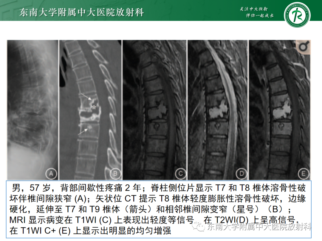 影像PPT - 【PPT】椎体孤立性肿瘤的诊断思路-37 影像PPT - 【PPT】椎体孤立性肿瘤的诊断思路-37