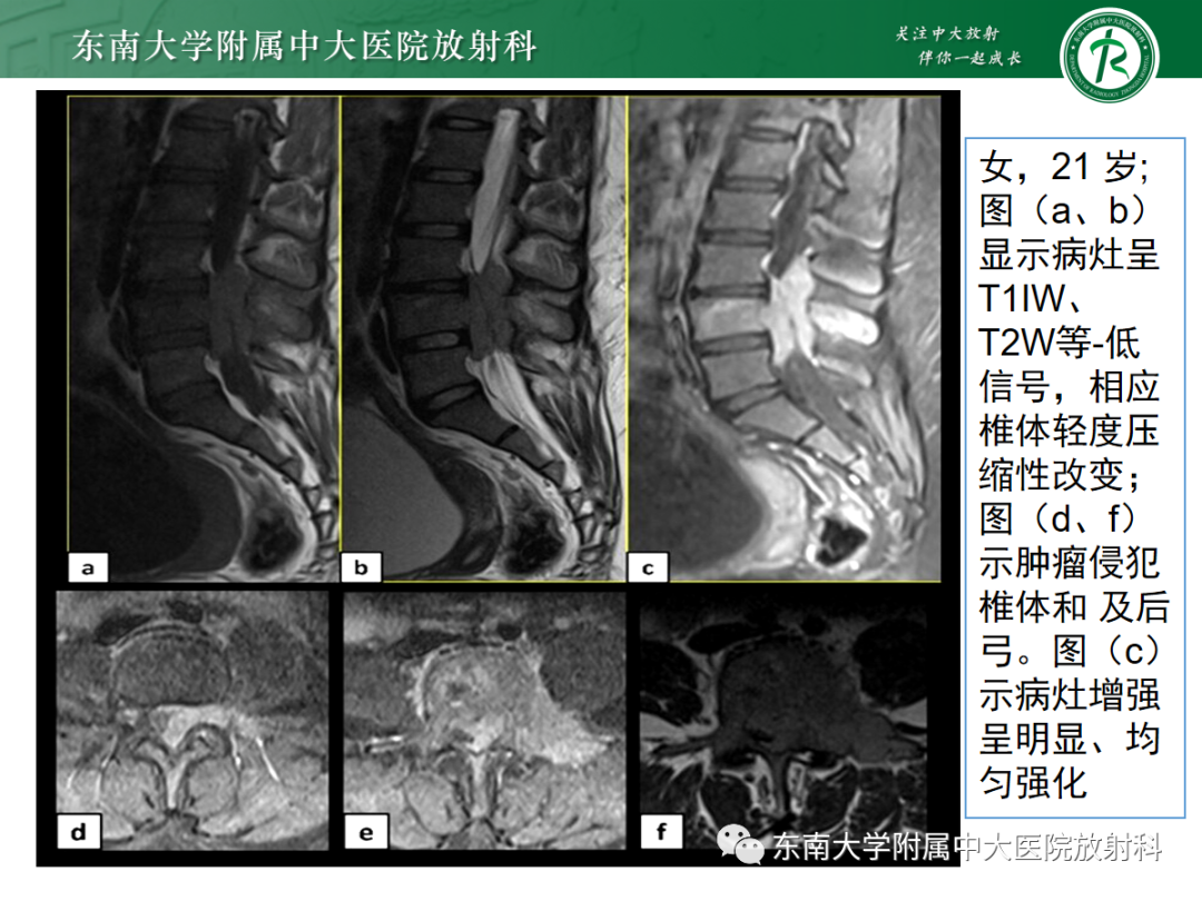 影像PPT - 【PPT】椎体孤立性肿瘤的诊断思路-38 影像PPT - 【PPT】椎体孤立性肿瘤的诊断思路-38