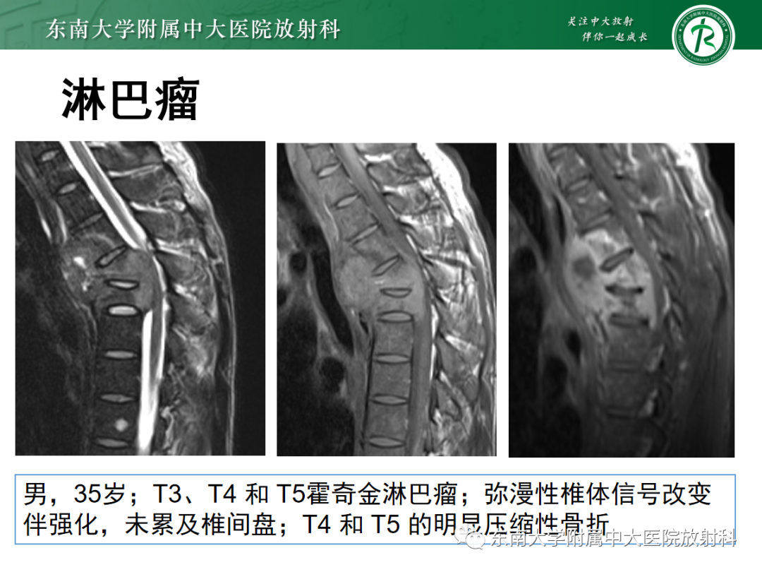 影像PPT - 【PPT】椎体孤立性肿瘤的诊断思路-40 影像PPT - 【PPT】椎体孤立性肿瘤的诊断思路-40