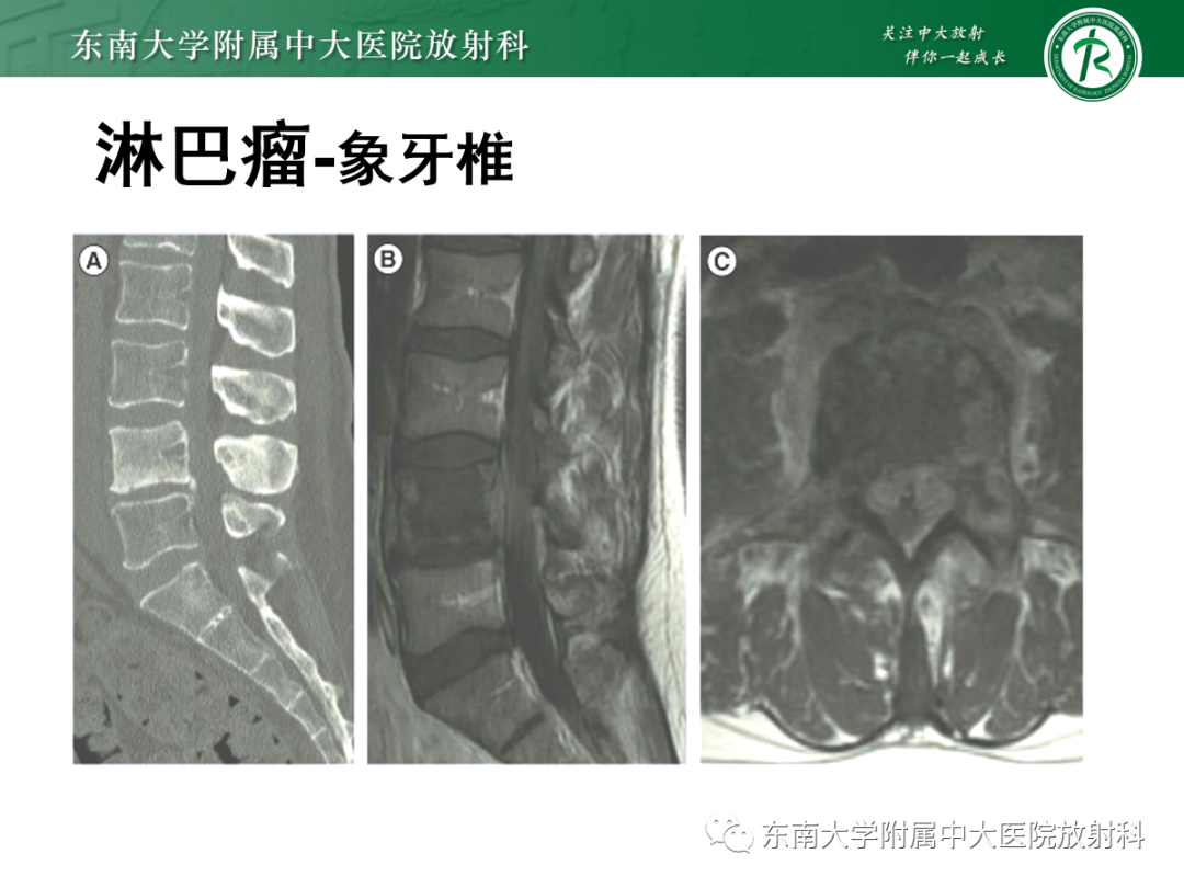 影像PPT - 【PPT】椎体孤立性肿瘤的诊断思路-41 影像PPT - 【PPT】椎体孤立性肿瘤的诊断思路-41