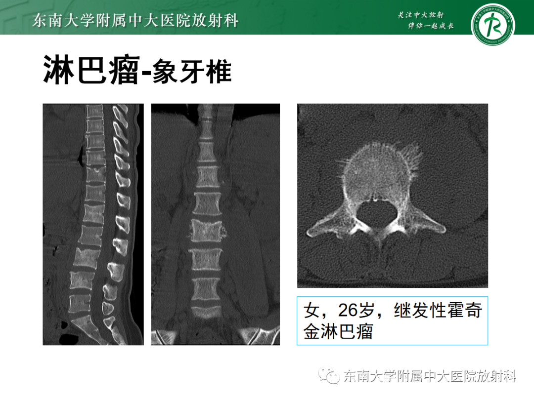 影像PPT - 【PPT】椎体孤立性肿瘤的诊断思路-42 影像PPT - 【PPT】椎体孤立性肿瘤的诊断思路-42