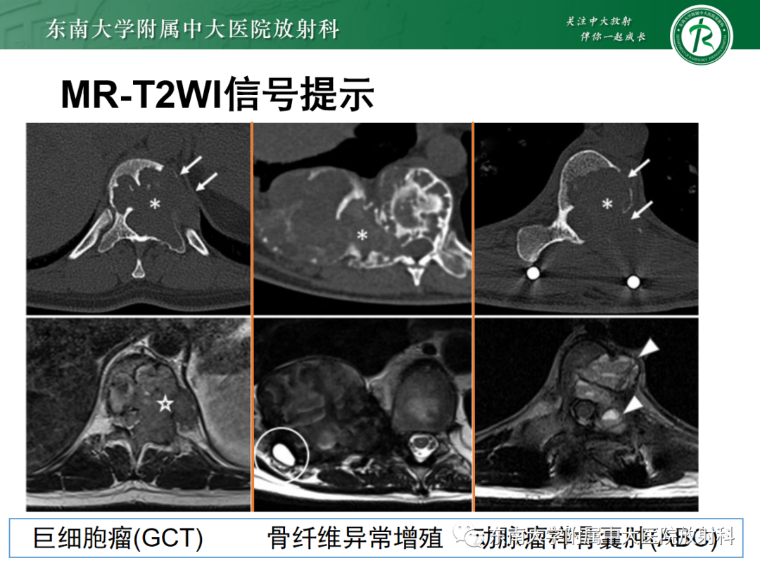 影像PPT - 【PPT】椎体孤立性肿瘤的诊断思路-47 影像PPT - 【PPT】椎体孤立性肿瘤的诊断思路-47