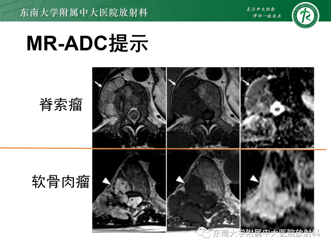 影像PPT - 【PPT】椎体孤立性肿瘤的诊断思路-48 影像PPT - 【PPT】椎体孤立性肿瘤的诊断思路-48