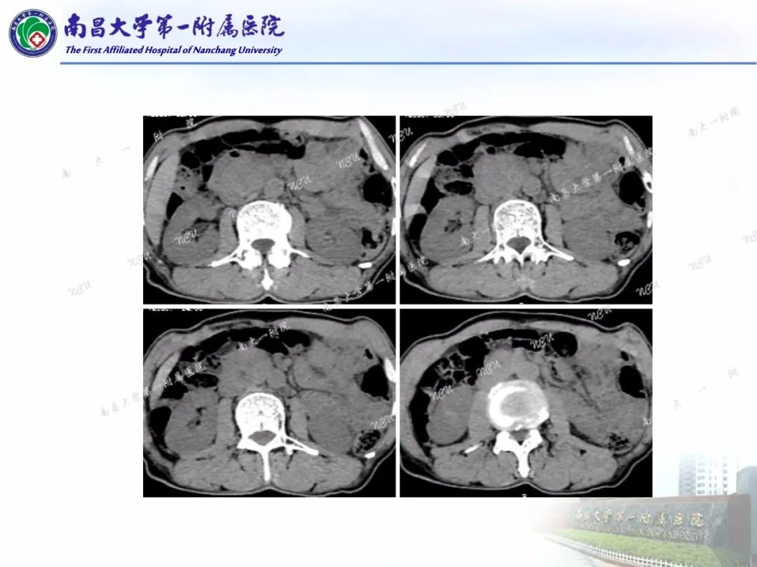 影像PPT - 【PPT】常见腹膜后肿瘤的诊断及鉴别诊断-3