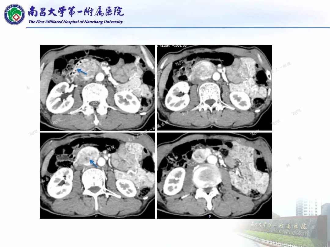 影像PPT - 【PPT】常见腹膜后肿瘤的诊断及鉴别诊断-4