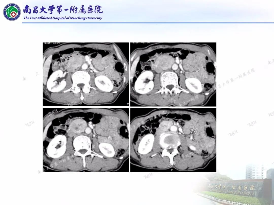 影像PPT - 【PPT】常见腹膜后肿瘤的诊断及鉴别诊断-5