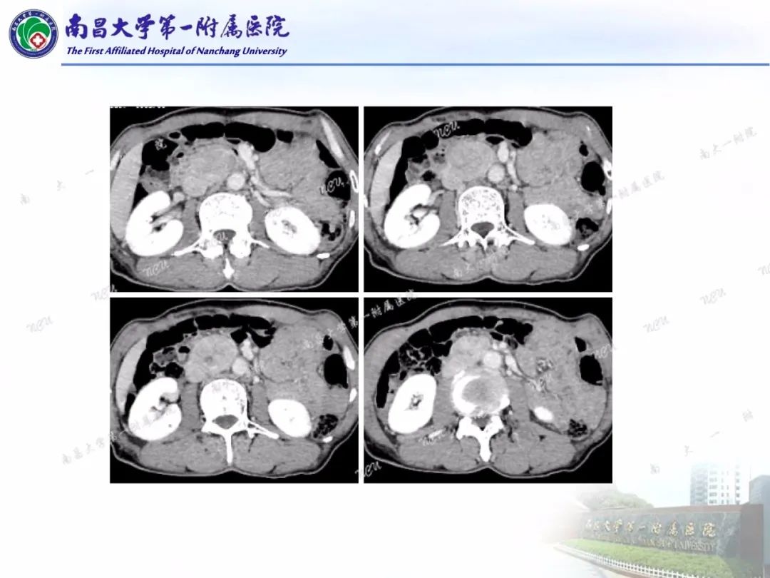 影像PPT - 【PPT】常见腹膜后肿瘤的诊断及鉴别诊断-6