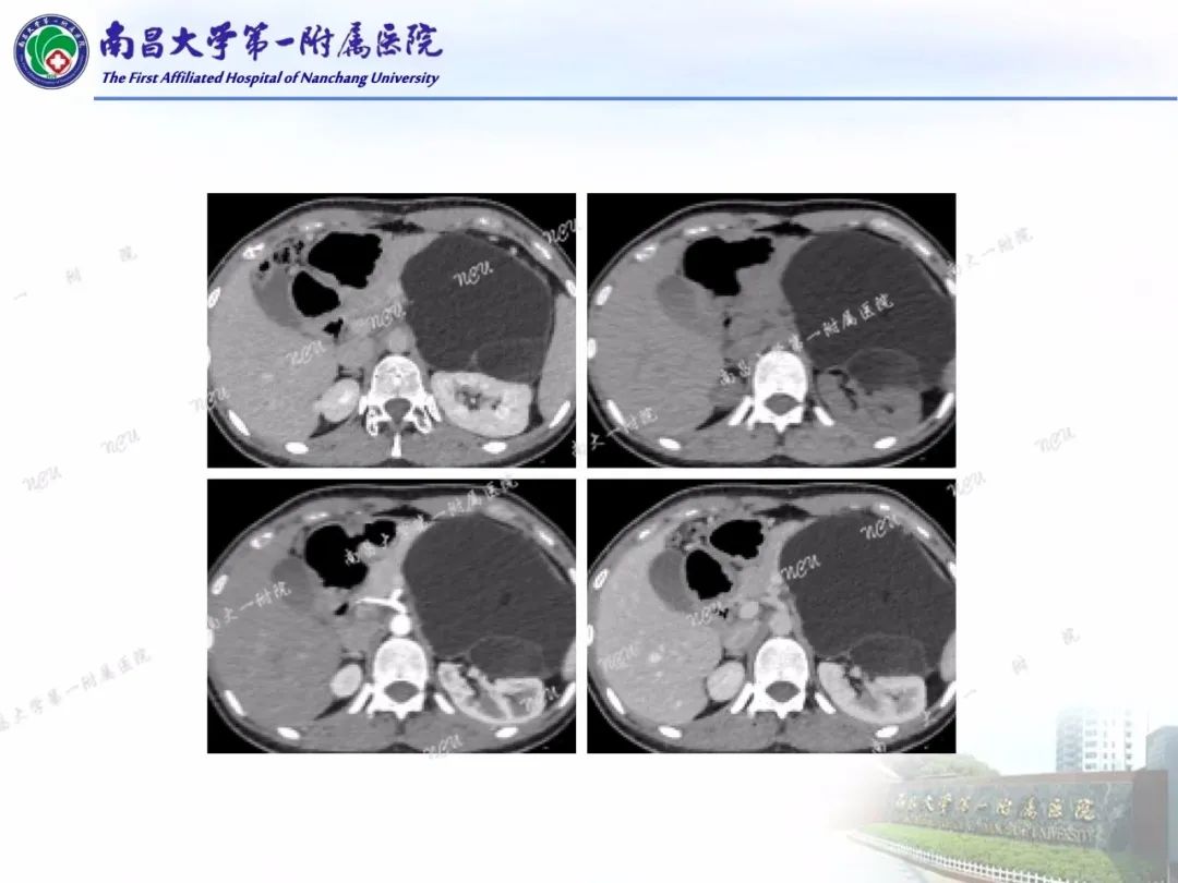 影像PPT - 【PPT】常见腹膜后肿瘤的诊断及鉴别诊断-10