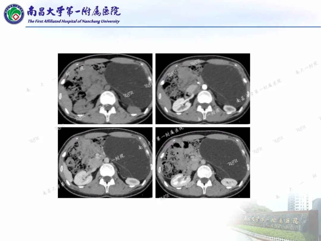 影像PPT - 【PPT】常见腹膜后肿瘤的诊断及鉴别诊断-11