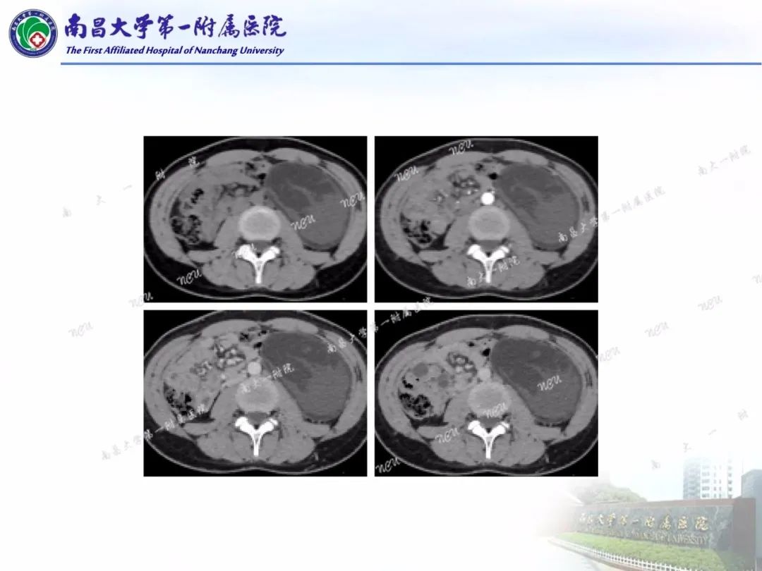影像PPT - 【PPT】常见腹膜后肿瘤的诊断及鉴别诊断-12