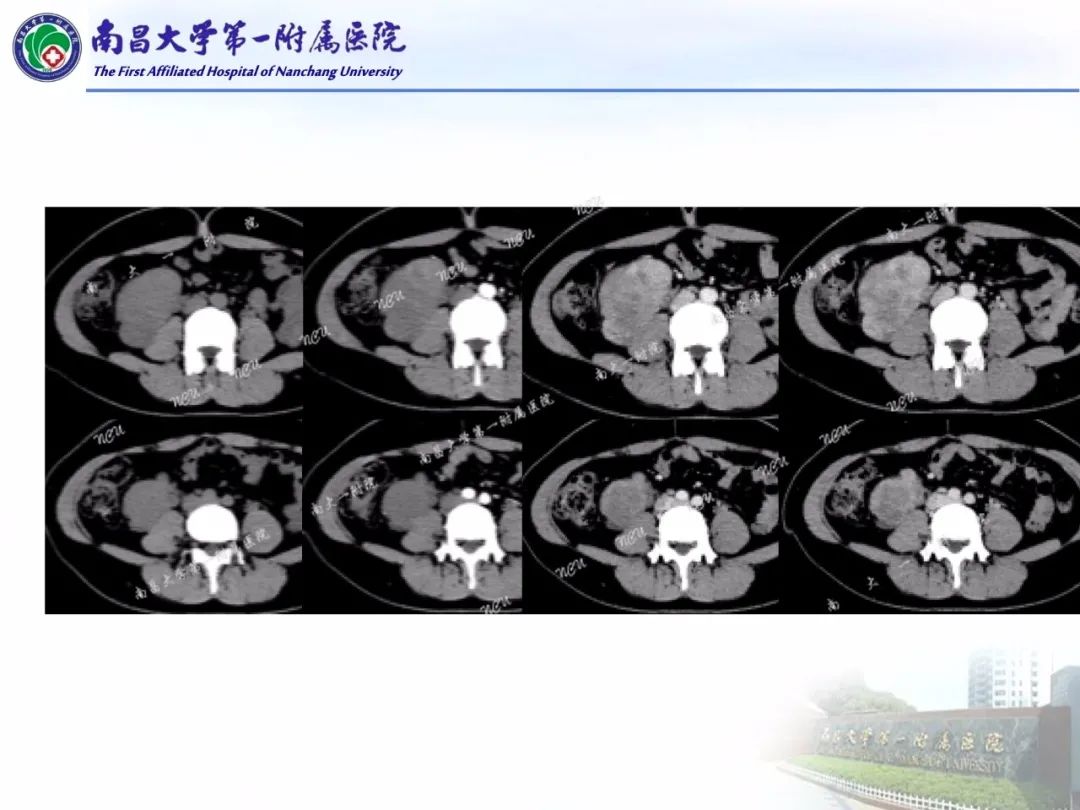 影像PPT - 【PPT】常见腹膜后肿瘤的诊断及鉴别诊断-15