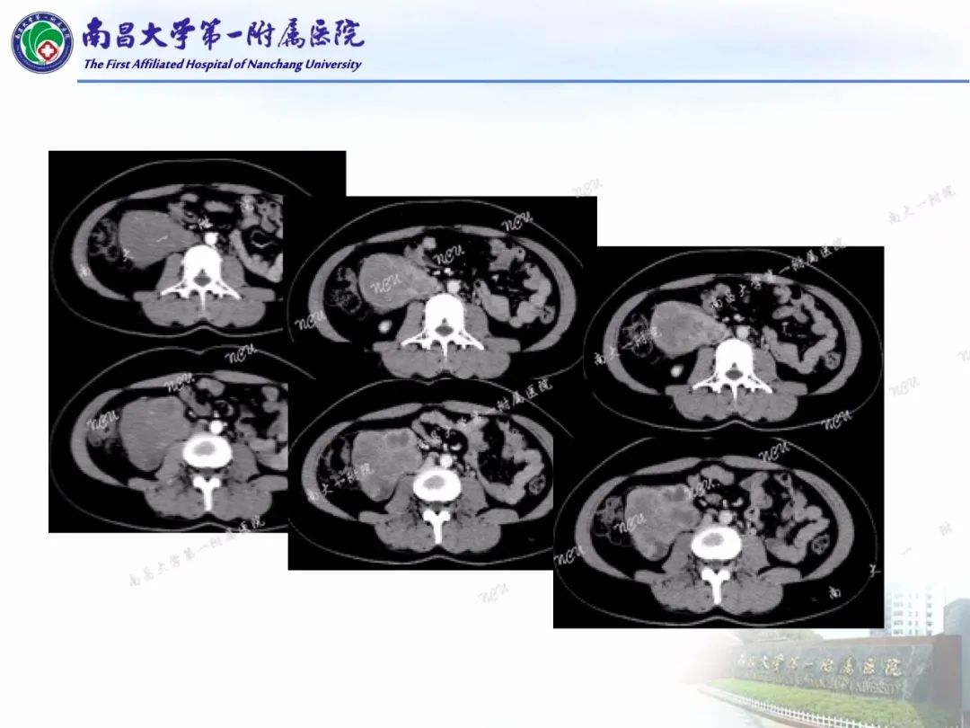 影像PPT - 【PPT】常见腹膜后肿瘤的诊断及鉴别诊断-16