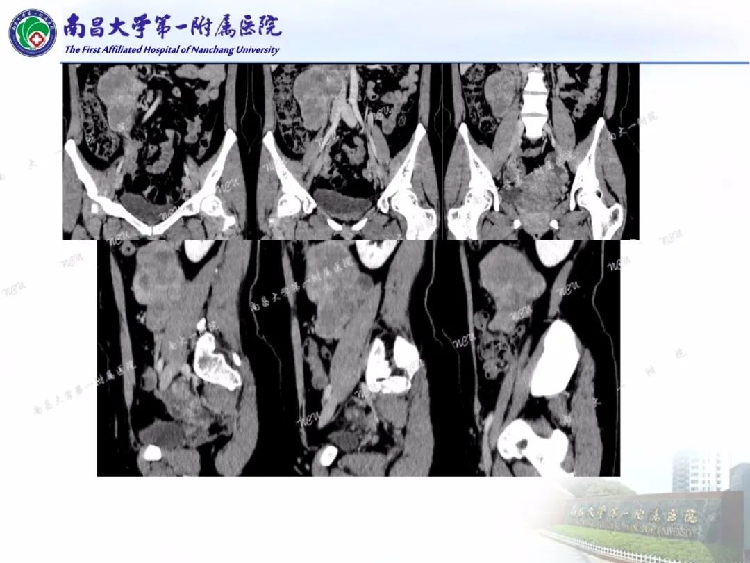 影像PPT - 【PPT】常见腹膜后肿瘤的诊断及鉴别诊断-17