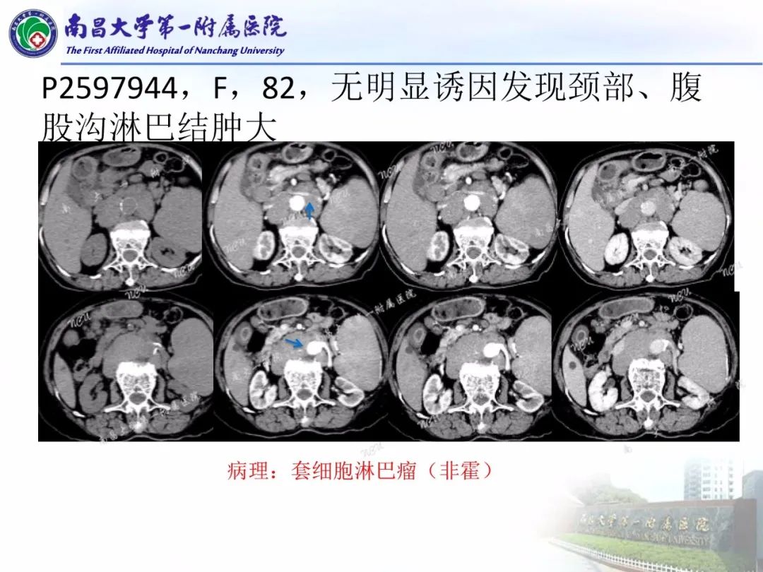 影像PPT - 【PPT】常见腹膜后肿瘤的诊断及鉴别诊断-33