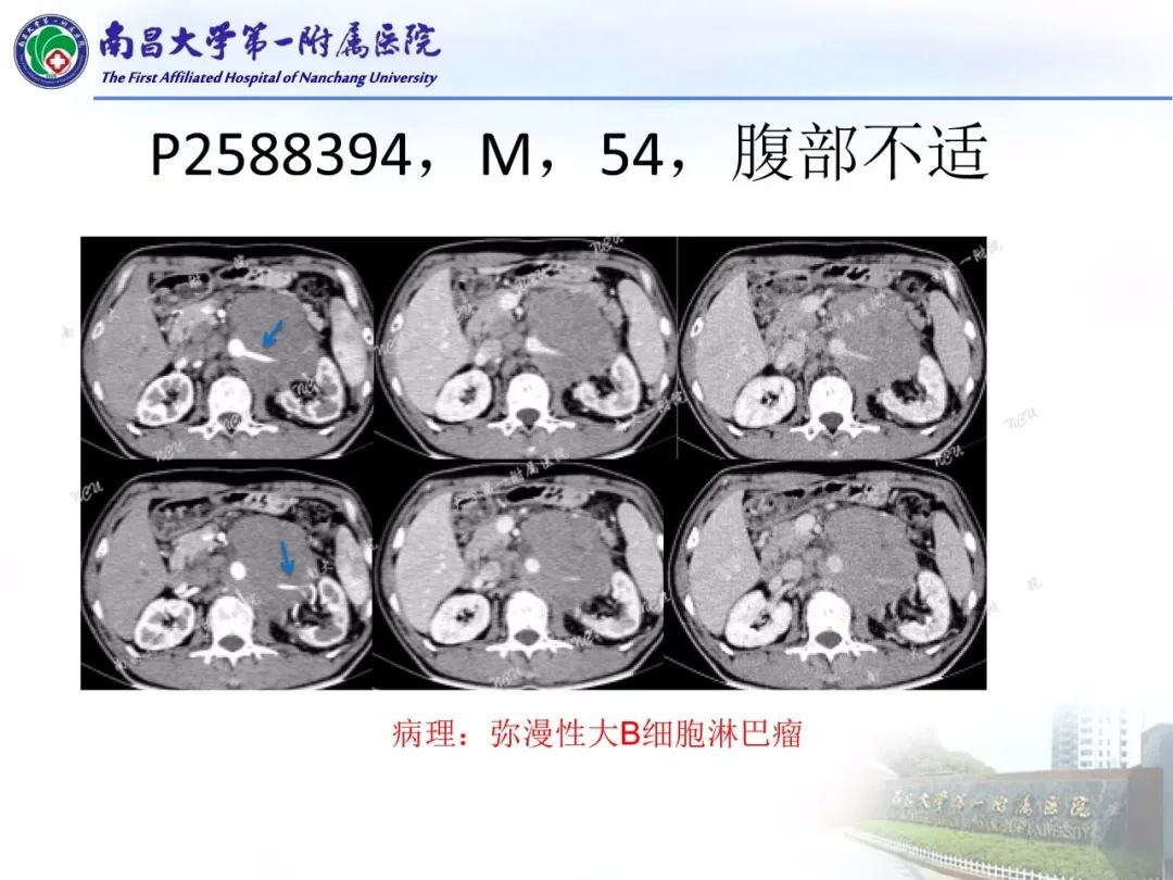 影像PPT - 【PPT】常见腹膜后肿瘤的诊断及鉴别诊断-34