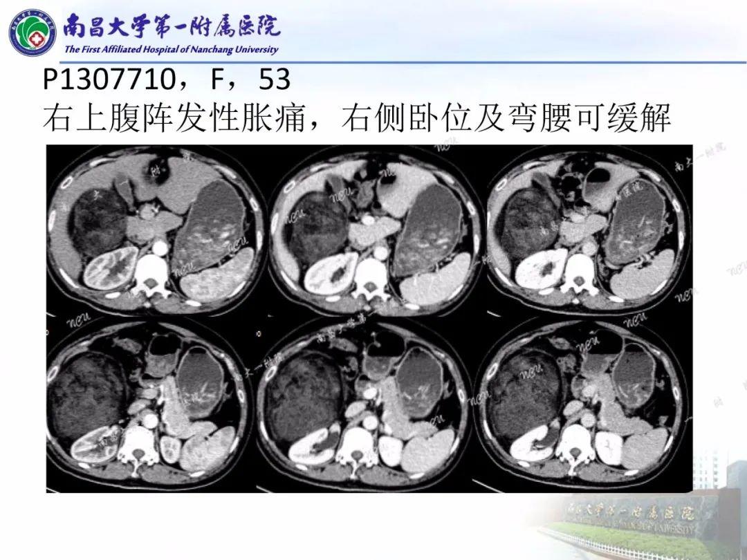 影像PPT - 【PPT】常见腹膜后肿瘤的诊断及鉴别诊断-36