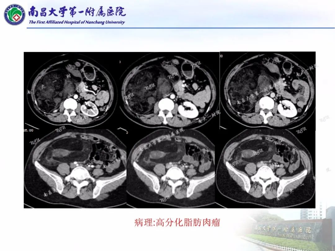 影像PPT - 【PPT】常见腹膜后肿瘤的诊断及鉴别诊断-37