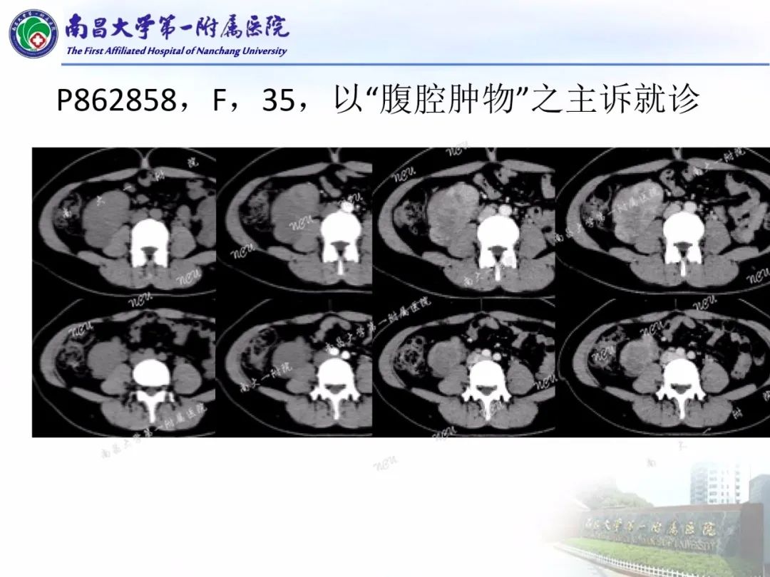 影像PPT - 【PPT】常见腹膜后肿瘤的诊断及鉴别诊断-39