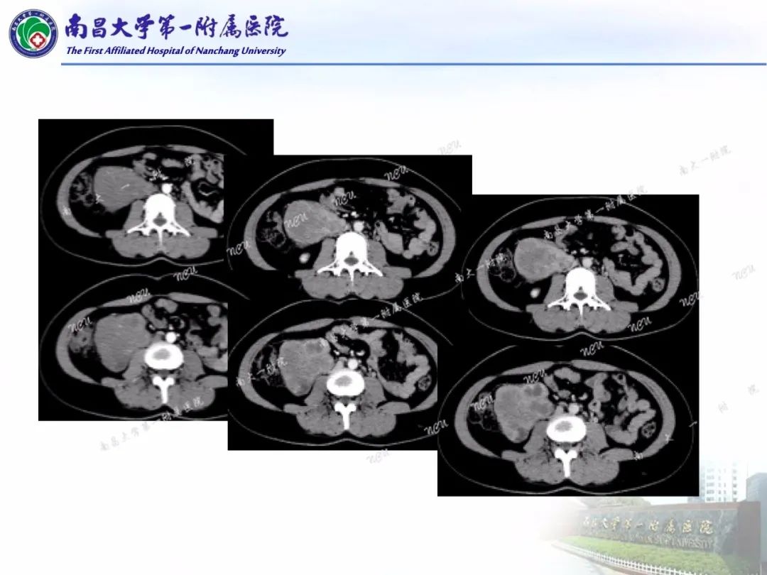 影像PPT - 【PPT】常见腹膜后肿瘤的诊断及鉴别诊断-40