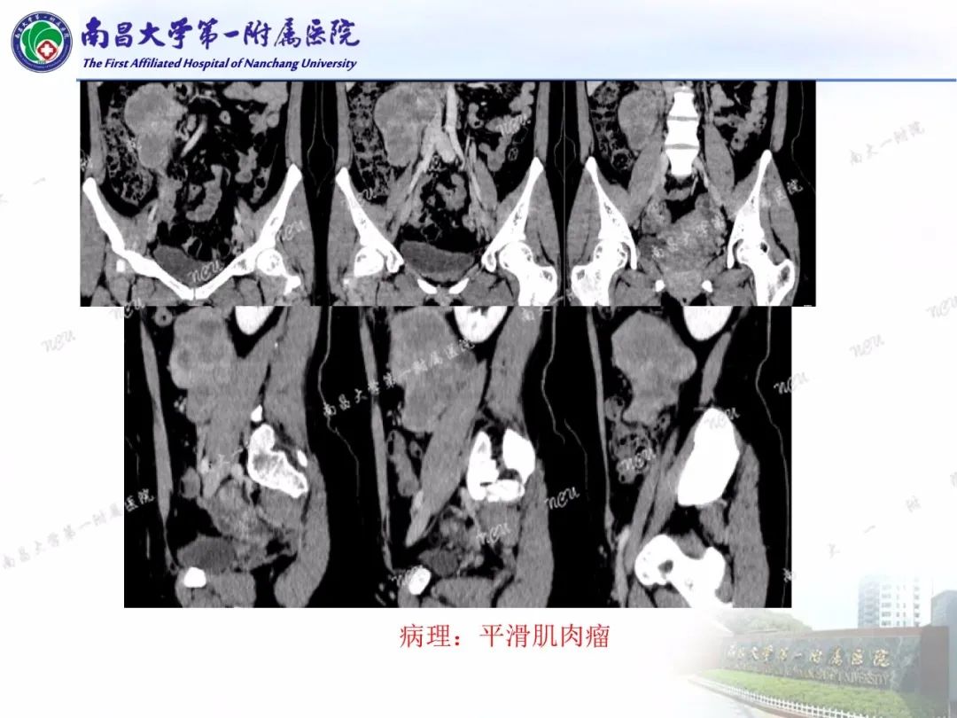 影像PPT - 【PPT】常见腹膜后肿瘤的诊断及鉴别诊断-41