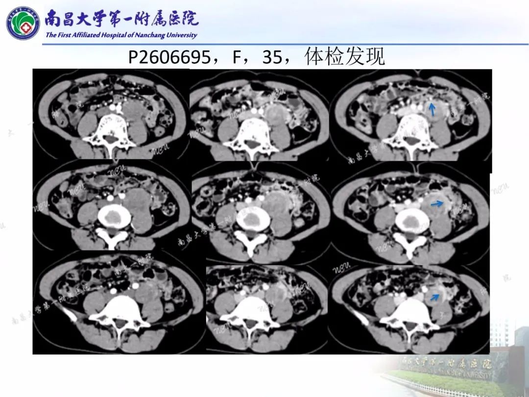 影像PPT - 【PPT】常见腹膜后肿瘤的诊断及鉴别诊断-43