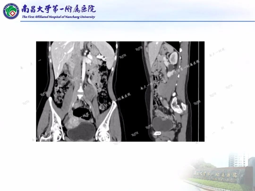影像PPT - 【PPT】常见腹膜后肿瘤的诊断及鉴别诊断-44
