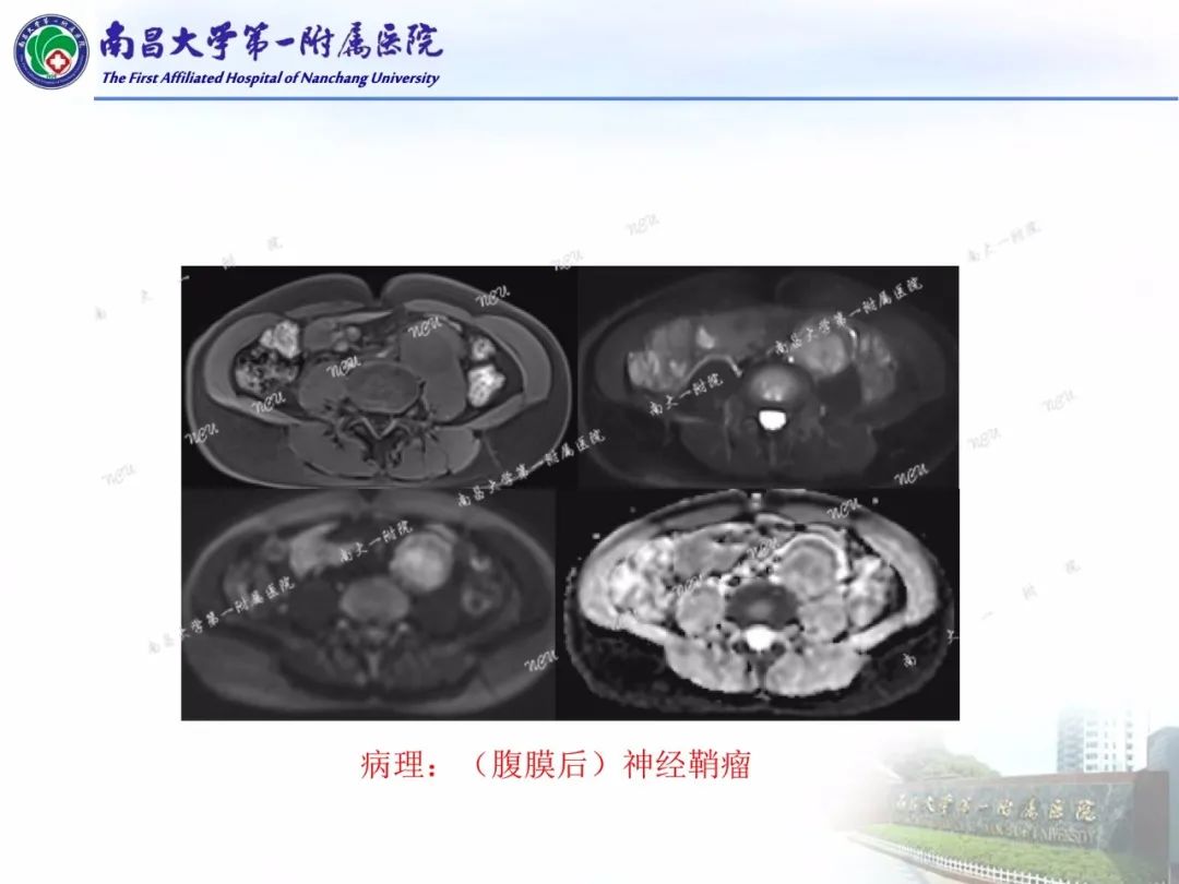 影像PPT - 【PPT】常见腹膜后肿瘤的诊断及鉴别诊断-45
