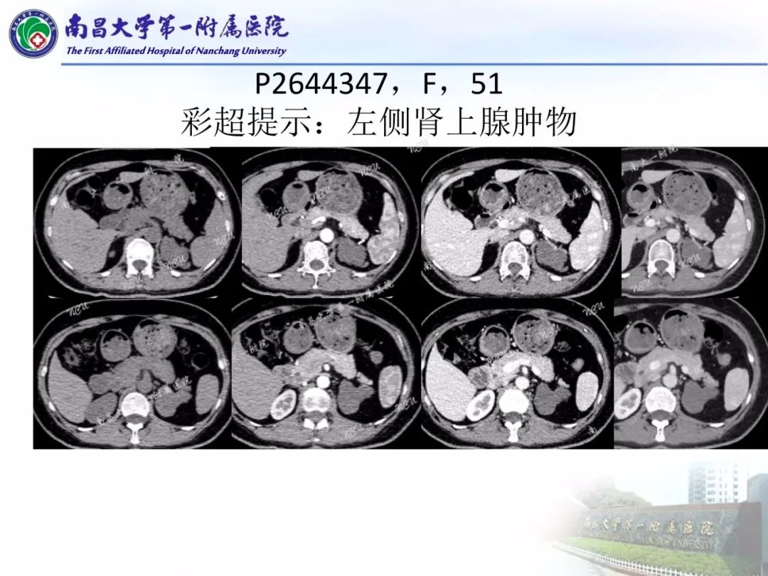 影像PPT - 【PPT】常见腹膜后肿瘤的诊断及鉴别诊断-49