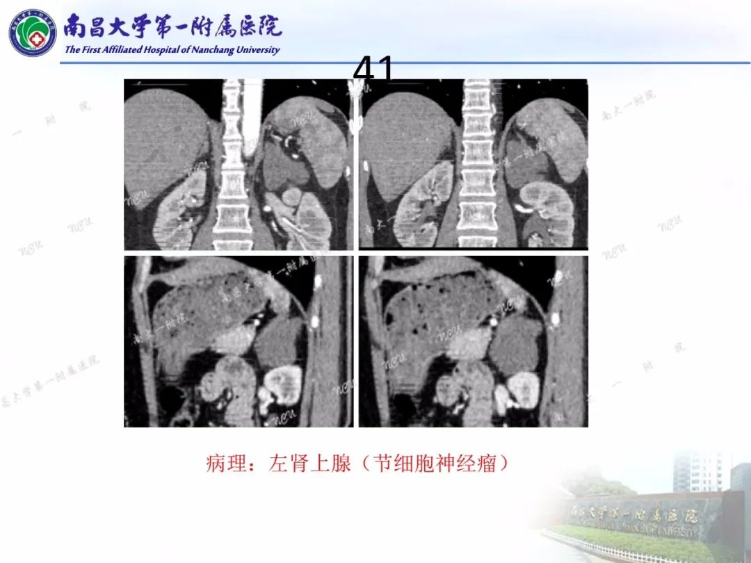 影像PPT - 【PPT】常见腹膜后肿瘤的诊断及鉴别诊断-50