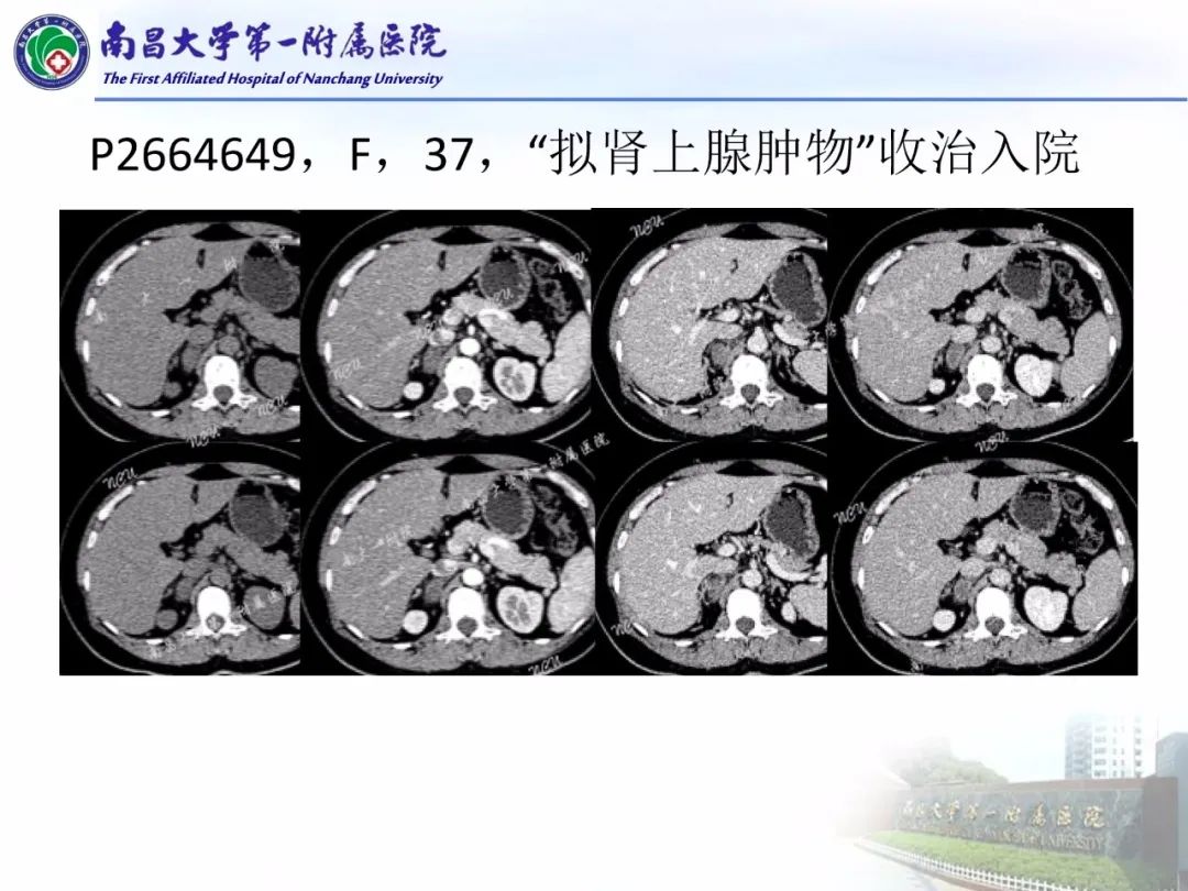 影像PPT - 【PPT】常见腹膜后肿瘤的诊断及鉴别诊断-51