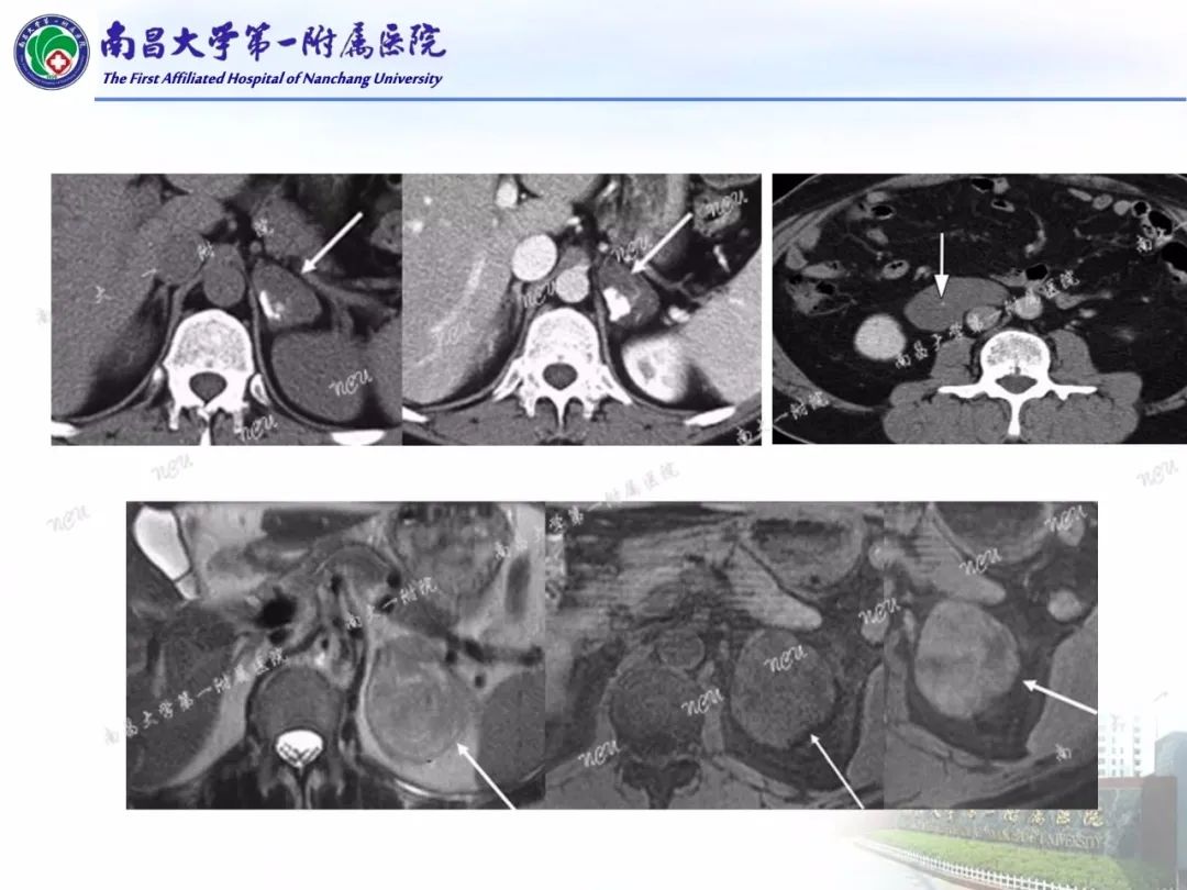 影像PPT - 【PPT】常见腹膜后肿瘤的诊断及鉴别诊断-52