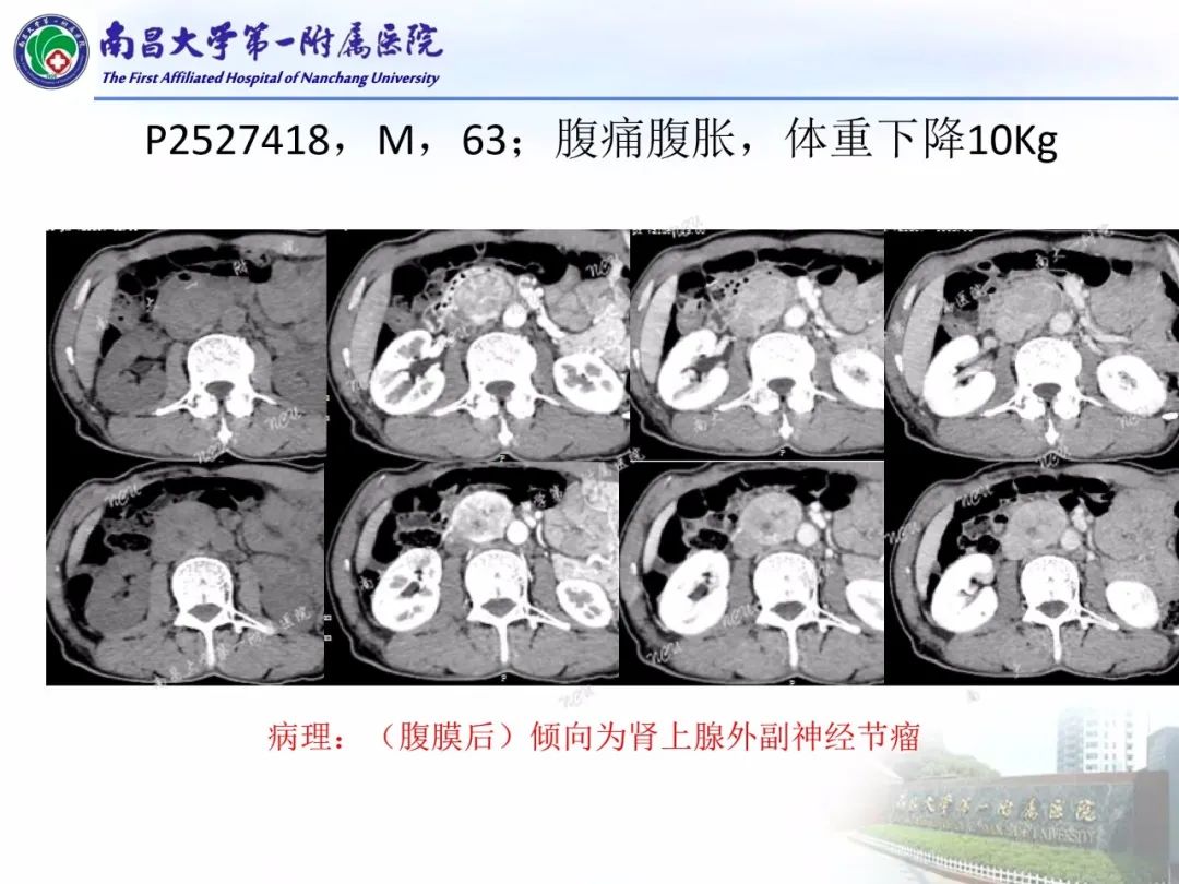 影像PPT - 【PPT】常见腹膜后肿瘤的诊断及鉴别诊断-55