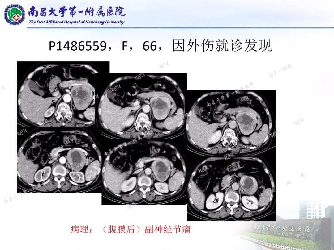 影像PPT - 【PPT】常见腹膜后肿瘤的诊断及鉴别诊断-56