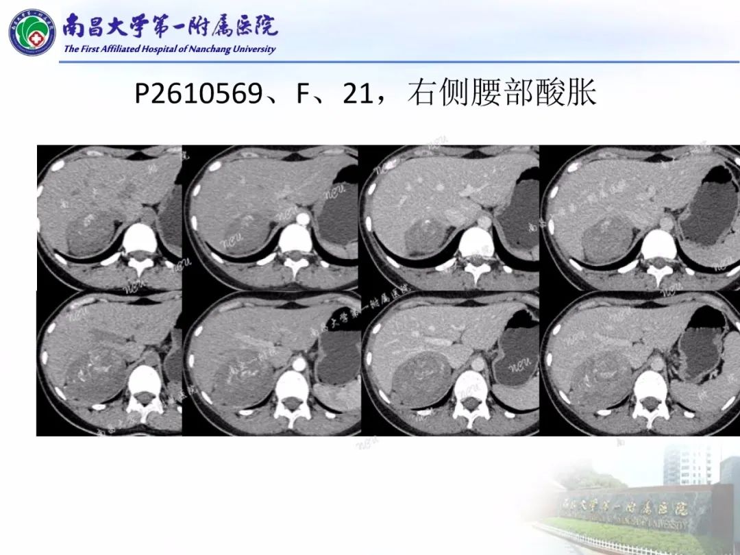 影像PPT - 【PPT】常见腹膜后肿瘤的诊断及鉴别诊断-59