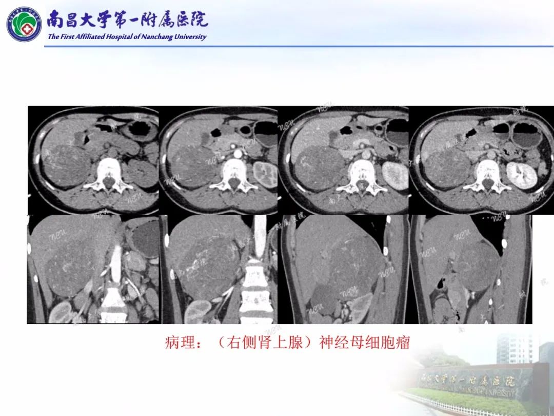 影像PPT - 【PPT】常见腹膜后肿瘤的诊断及鉴别诊断-60