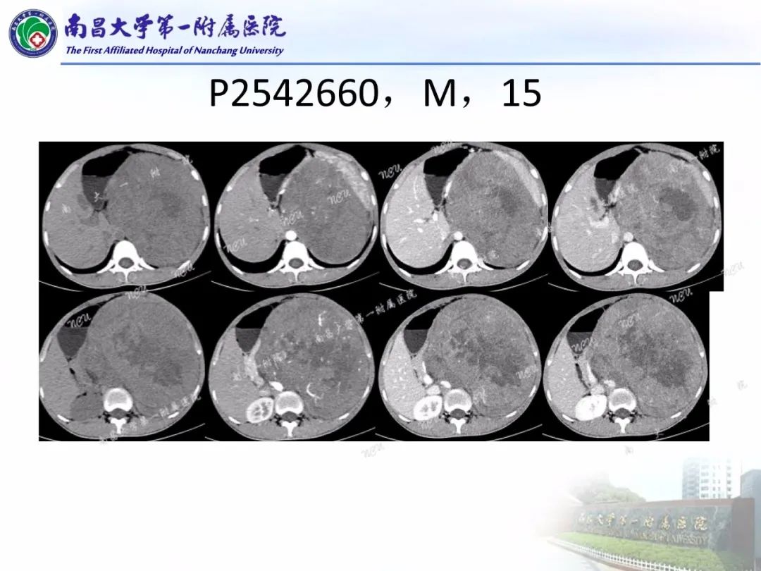 影像PPT - 【PPT】常见腹膜后肿瘤的诊断及鉴别诊断-61