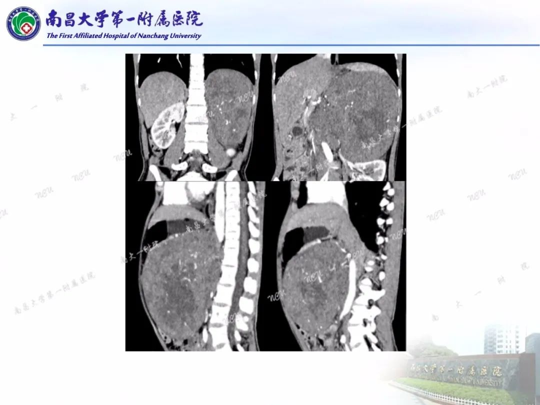 影像PPT - 【PPT】常见腹膜后肿瘤的诊断及鉴别诊断-62