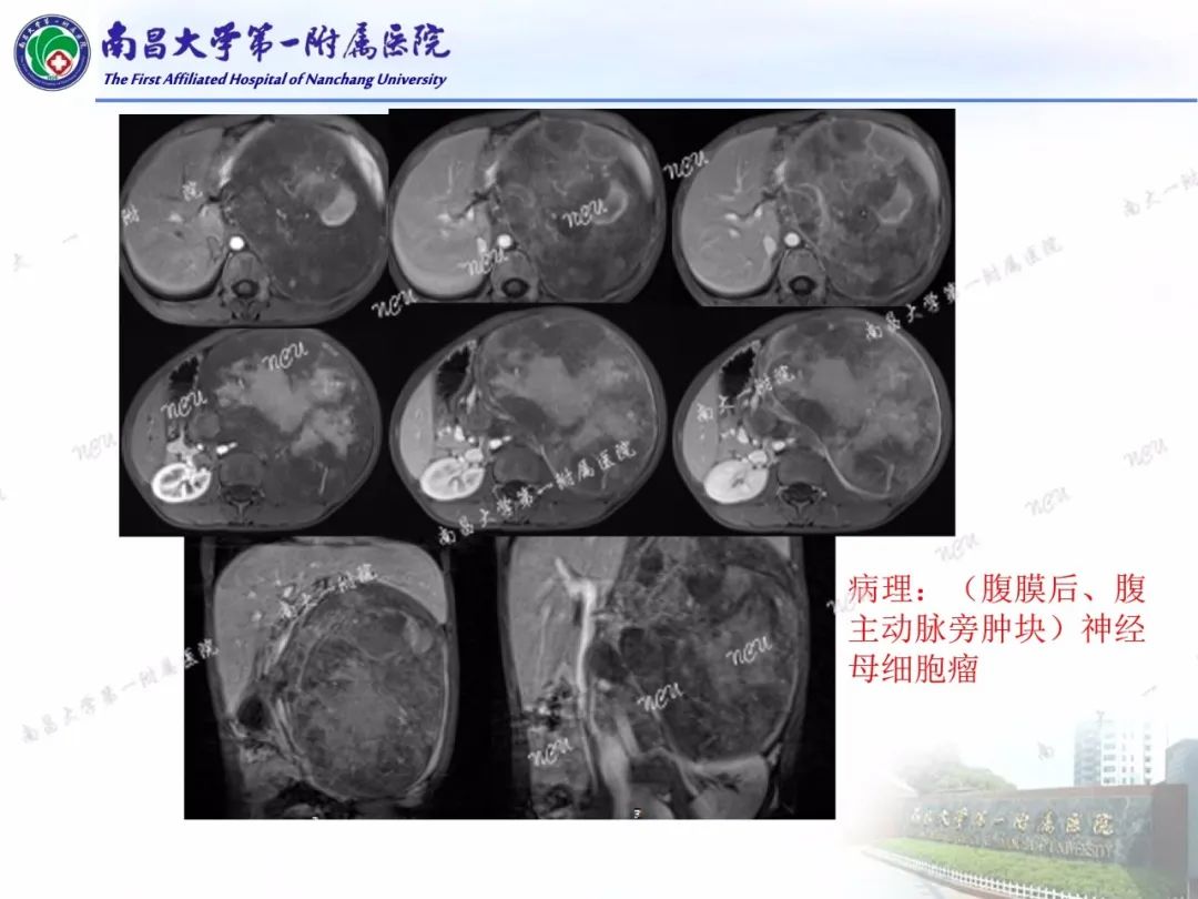 影像PPT - 【PPT】常见腹膜后肿瘤的诊断及鉴别诊断-64