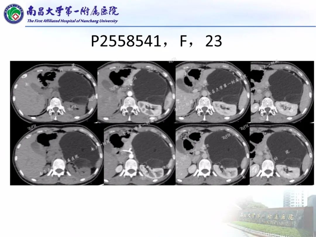 影像PPT - 【PPT】常见腹膜后肿瘤的诊断及鉴别诊断-66