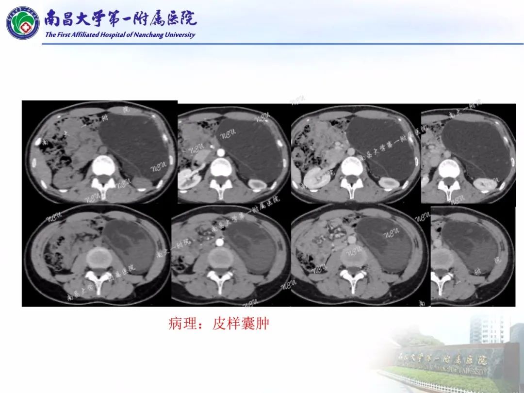 影像PPT - 【PPT】常见腹膜后肿瘤的诊断及鉴别诊断-67