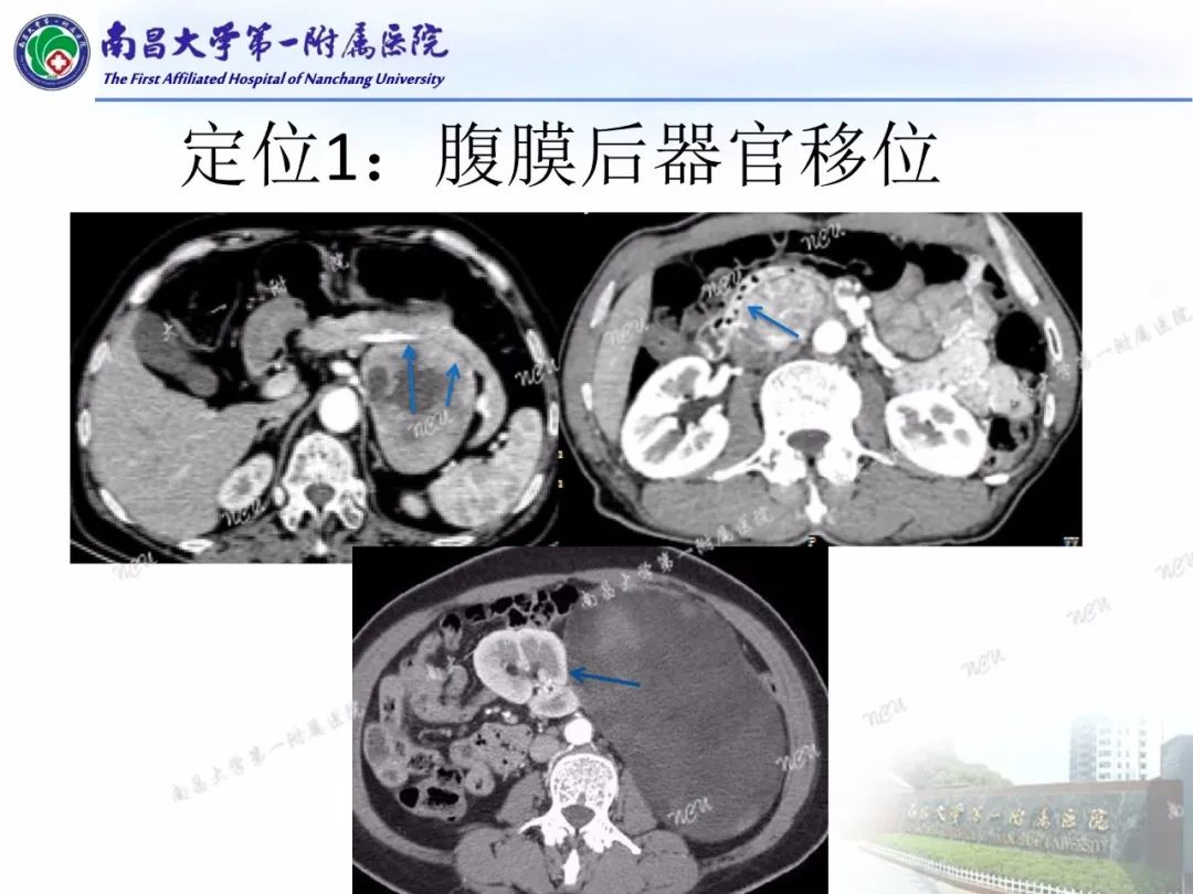 影像PPT - 【PPT】常见腹膜后肿瘤的诊断及鉴别诊断-69
