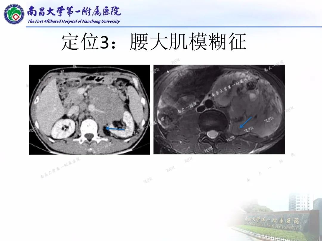 影像PPT - 【PPT】常见腹膜后肿瘤的诊断及鉴别诊断-71